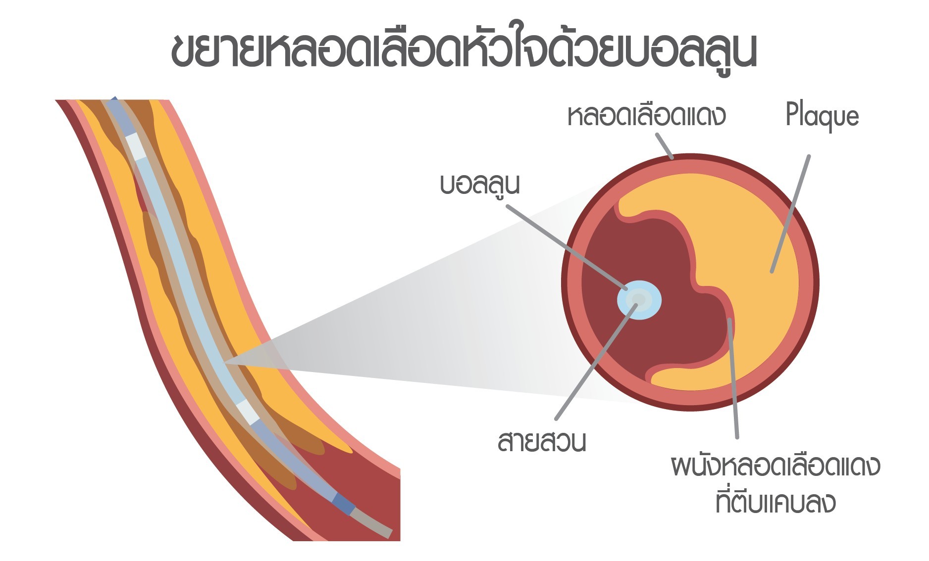 ขยายหลอดเลือดหัวใจด้วยบอลลูน