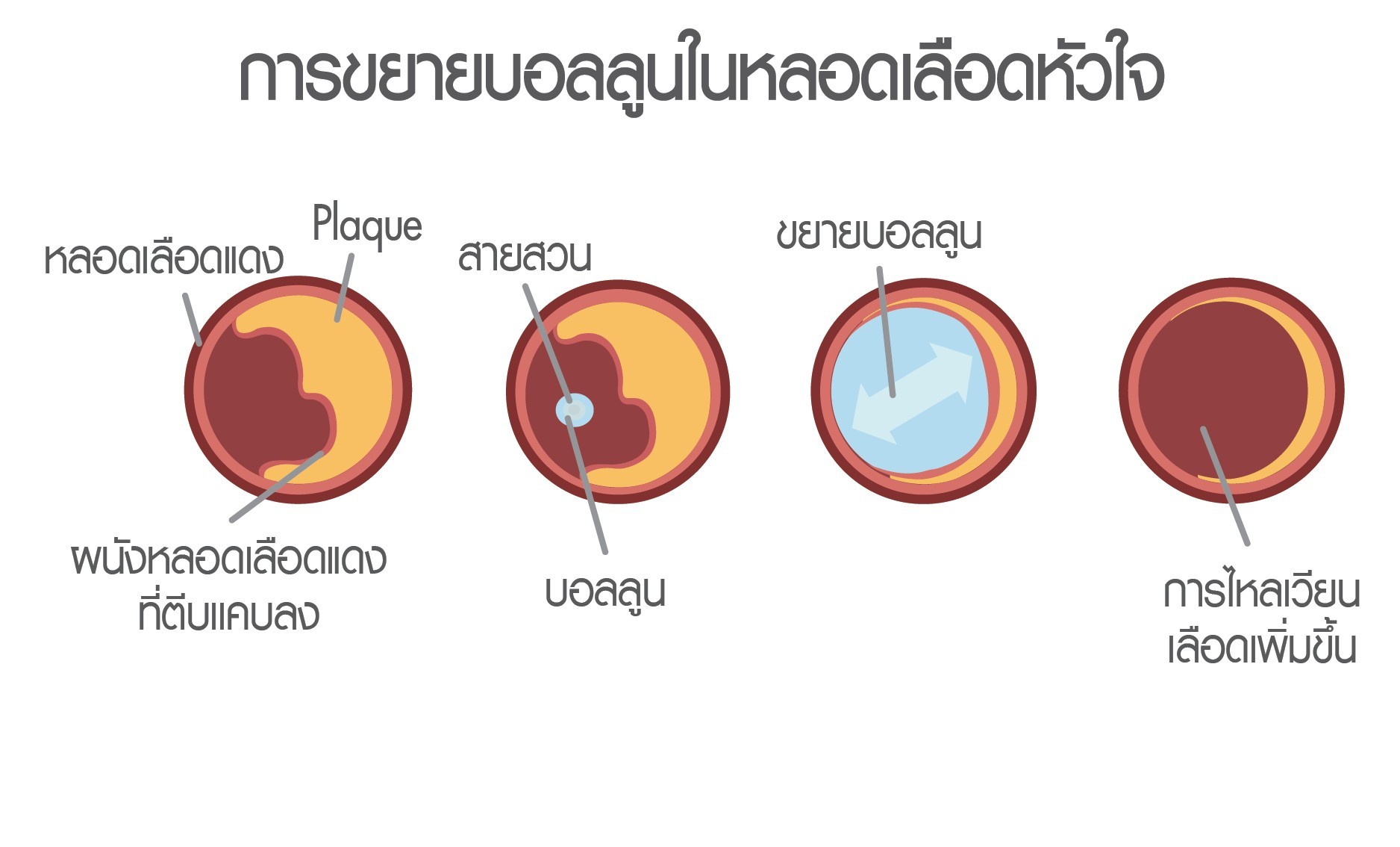 ขยายหลอดเลือดหัวใจด้วยบอลลูน